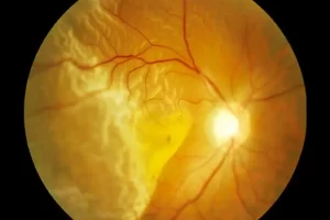 Descolamento de retina: sintomas, causas e tratamento