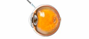 Injeção intravítrea: quando é indicada e como funciona