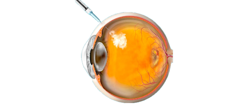 Injeção intravítrea: quando é indicada e como funciona