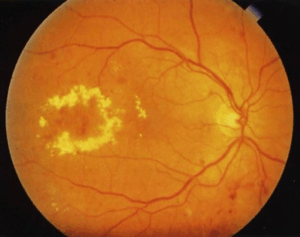 Edema macular diabético: causas, sintomas e tratamento