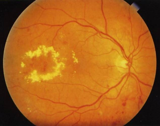 Edema macular diabético: causas, sintomas e tratamento