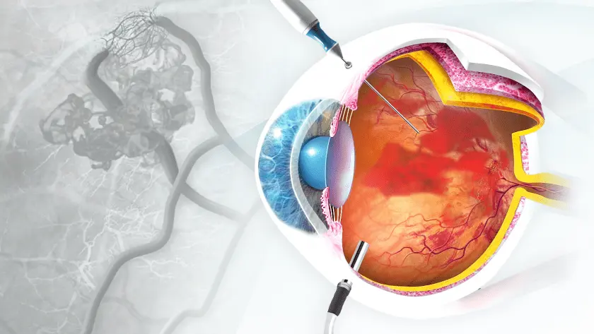 Oclusão vascular da retina: causas, sintomas e tratamento