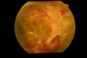Retinopatia diabética: causas, sintomas e tratamentos atuais