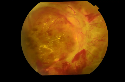 Retinopatia diabética: causas, sintomas e tratamentos atuais