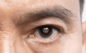 Catarata Secundária: Entenda o Que É e Como o Tratamento a Laser Restaura a Visão