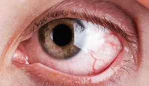 Olho Seco Tratamento: Um Guia Completo para Alívio e Qualidade de Vida