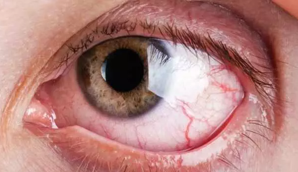 Olho Seco Tratamento: Um Guia Completo para Alívio e Qualidade de Vida