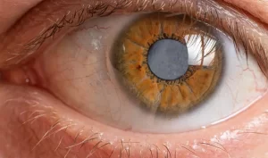 Catarata pode cegar? Entenda riscos, sintomas e prevenção