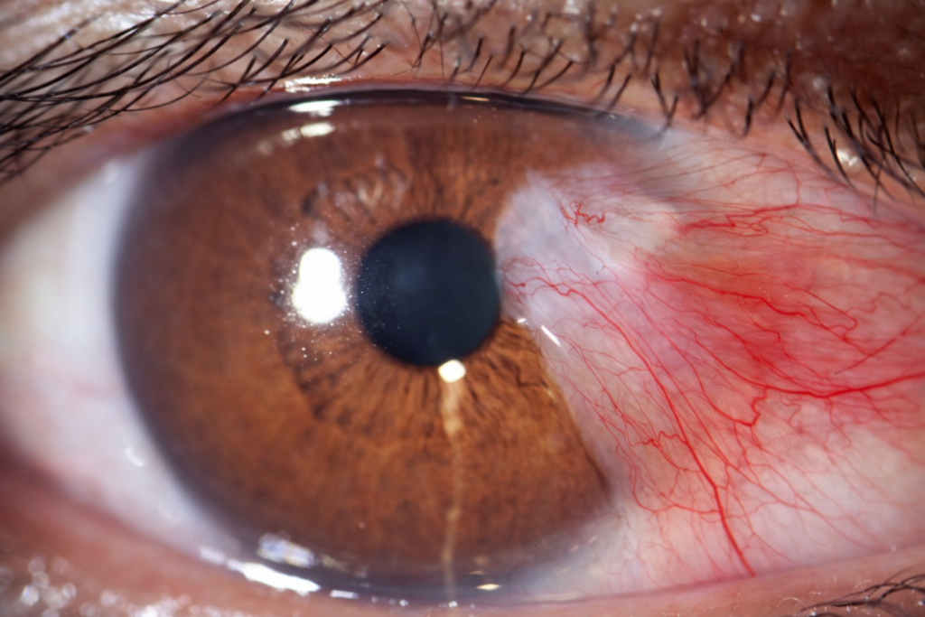 Pterígio: causas, sintomas e tratamento da “carne crescida” nos olhos