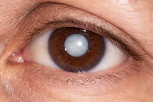 Catarata no olho: sintomas, causas e quando operar