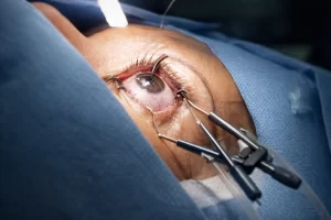 Cirurgia de correção de grau: o que avaliar antes de decidir