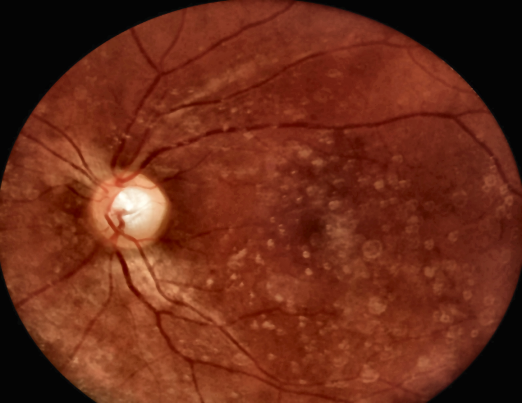 Retinografia: para que serve, quando é indicada e como se preparar