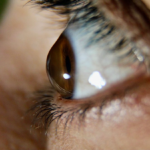 Ceratocone é grave? Entenda quando a doença pode piorar