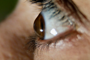 Ceratocone é grave? Entenda quando a doença pode piorar