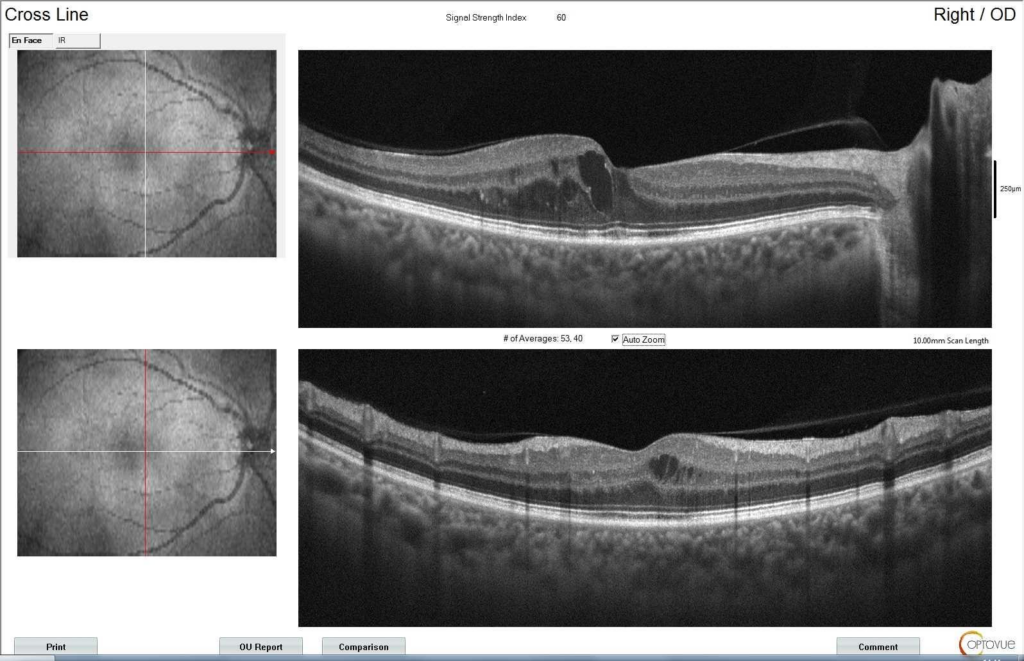 Edema macular: o que você precisa saber para proteger sua visão