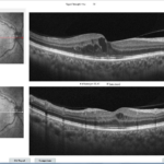 Edema macular: o que você precisa saber para proteger sua visão