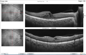 Edema macular: o que você precisa saber para proteger sua visão