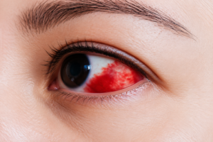 Hemorragia Subconjuntival: Sinais de Alerta que Você Precisa Conhecer