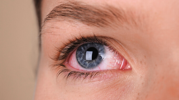 Olhos Vermelhos: Causas, Sinais de Alerta e Quando Procurar um Especialista