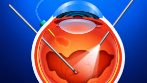 Vitrectomia: quando a cirurgia do vítreo é necessária e o que esperar