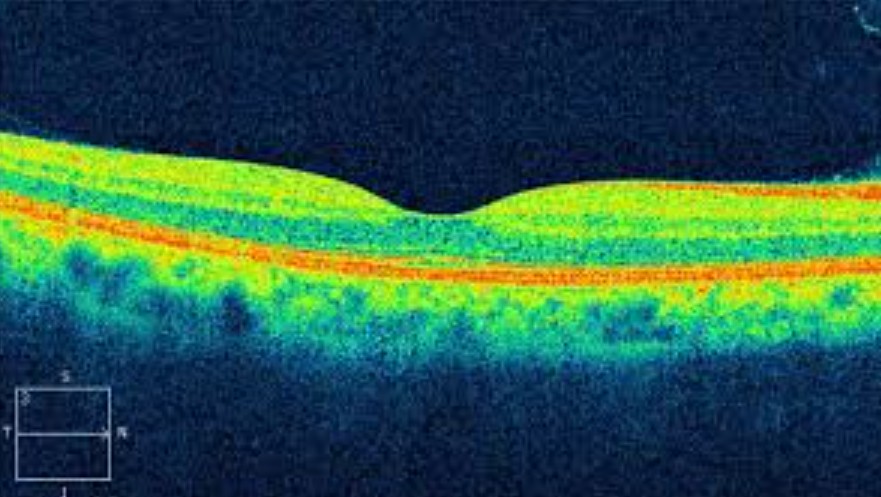 OCT: o exame que enxerga o que os olhos não mostram — OCT x outros exames de retina: quando cada um é indicado
