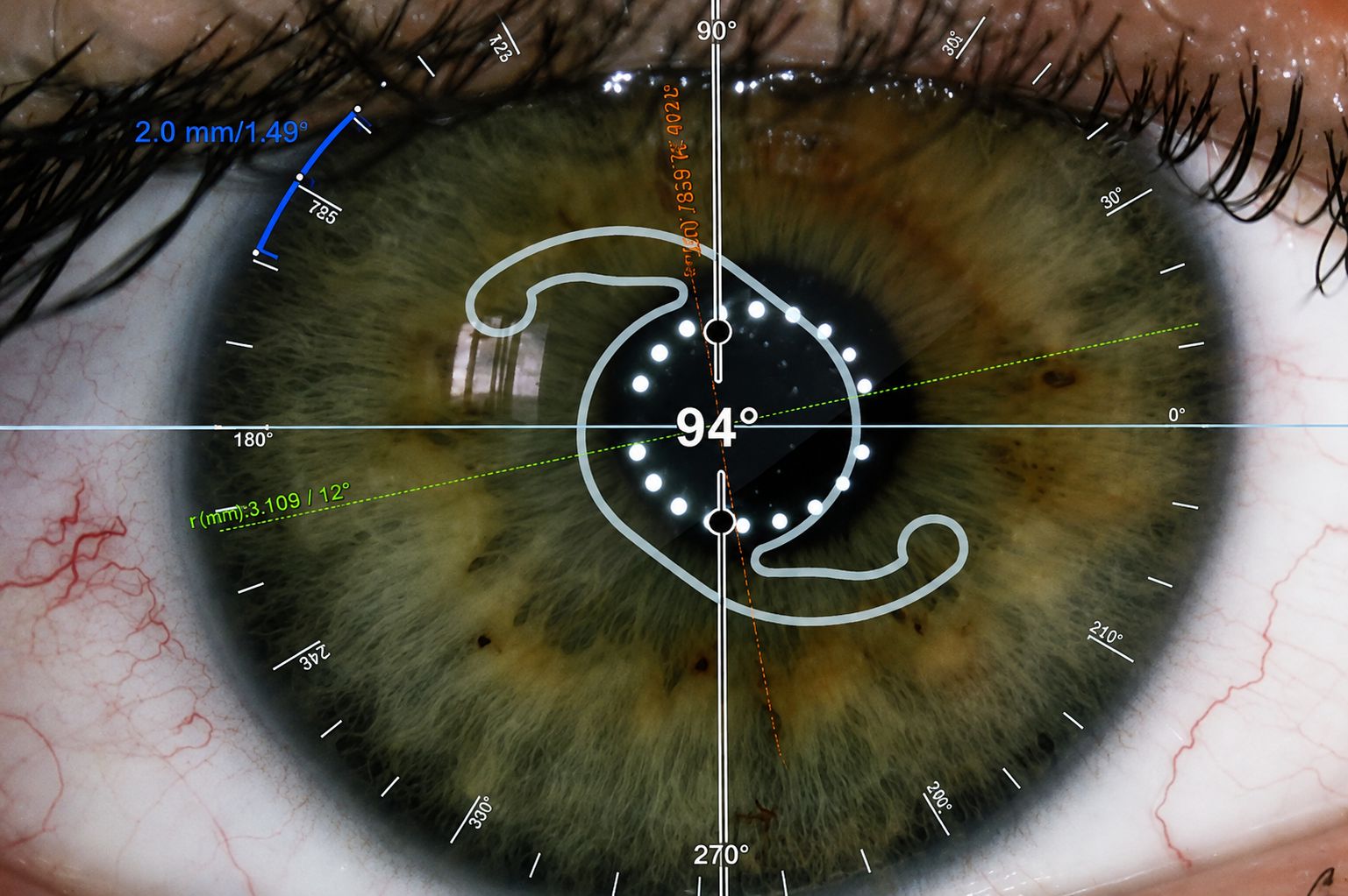 Biometria ótica antes da cirurgia de catarata: por que a precisão do cálculo da lente é tão importante? — O planejamento individualizado como diferencial