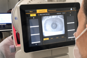 Biometria ótica antes da cirurgia de catarata: por que a precisão do cálculo da lente é tão importante?