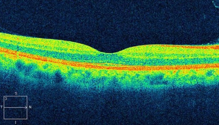 Tomografia de coerência ótica: como o exame avalia a mácula e o nervo óptico? — O resultado precisa de interpretação clínica