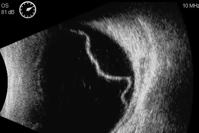 Ultrassom ocular em pacientes com catarata: quando o exame ajuda a avaliar a retina? — Como é feita a ultrassonografia ocular