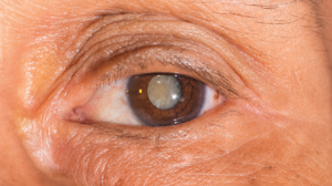 Ultrassom ocular em pacientes com catarata: quando o exame ajuda a avaliar a retina?